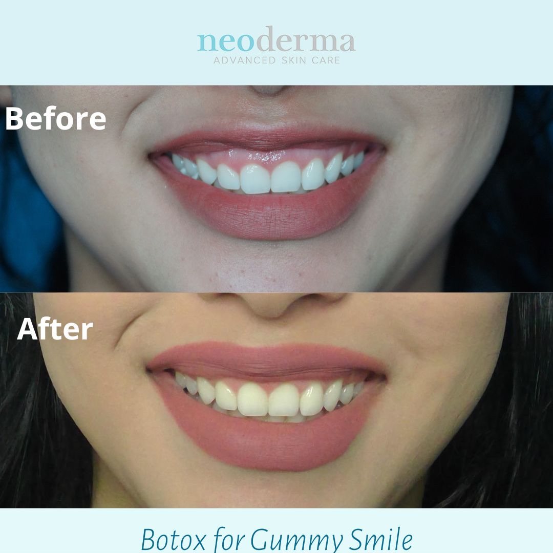 Before and after Botox for a gummy smile at Neoderma Anaheim: less gum showing above the teeth in a full smile
