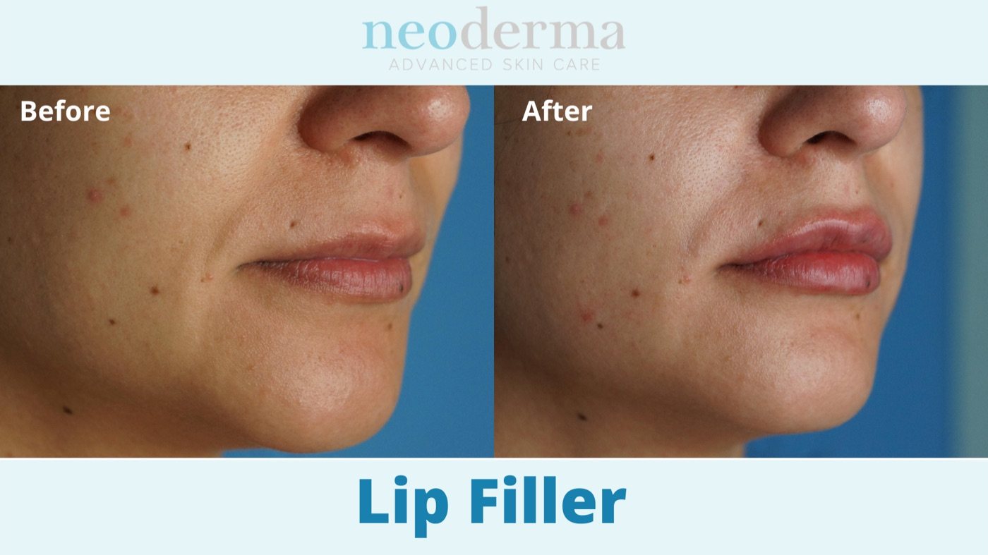 Before and after natural lip filler at Neoderma Anaheim: fuller, defined lips with a conservative amount of product
