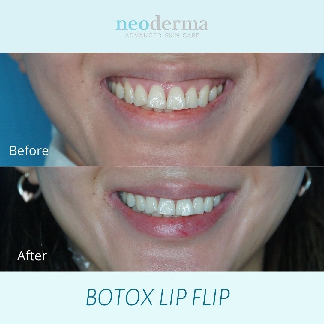 Before and after a Botox lip flip at Neoderma Anaheim: smiling, the upper lip rolls outward to show more pink with no added volume