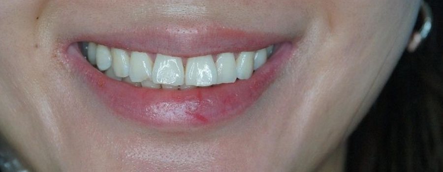 After a Botox lip flip at Neoderma Anaheim: the same smile with the upper lip rolled outward and more pink showing