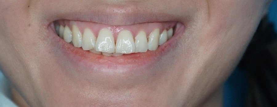 Before a Botox lip flip: smiling, the upper lip thins and tucks inward over the teeth